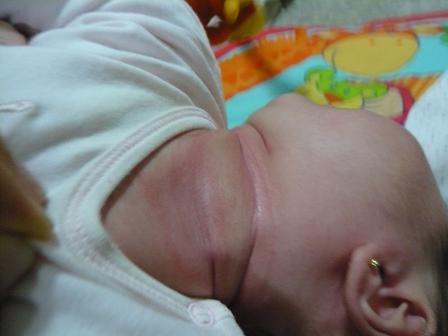 首 後ろ 赤ちゃん 赤い の 赤ちゃんの首に湿疹！原因や治療法は？後ろにブツブツ？