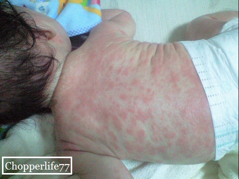 Chopperlife77 母乳の食事と乳児湿疹の関係