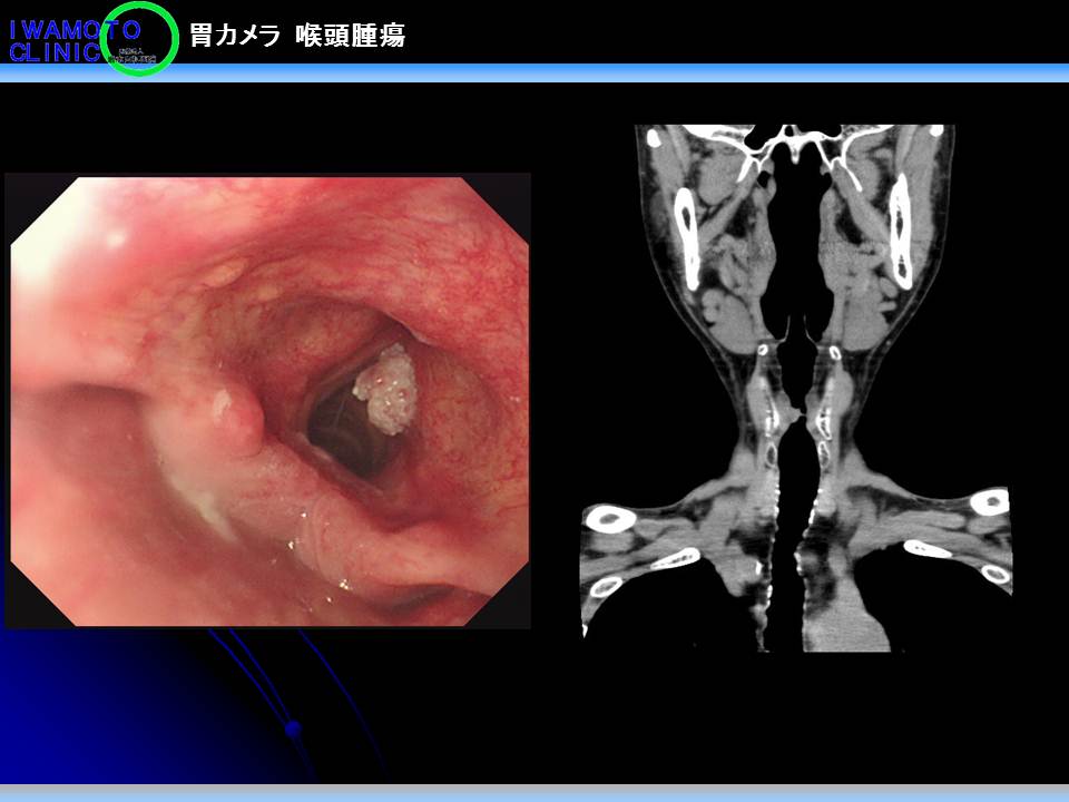 胃カメラ　喉頭腫瘍