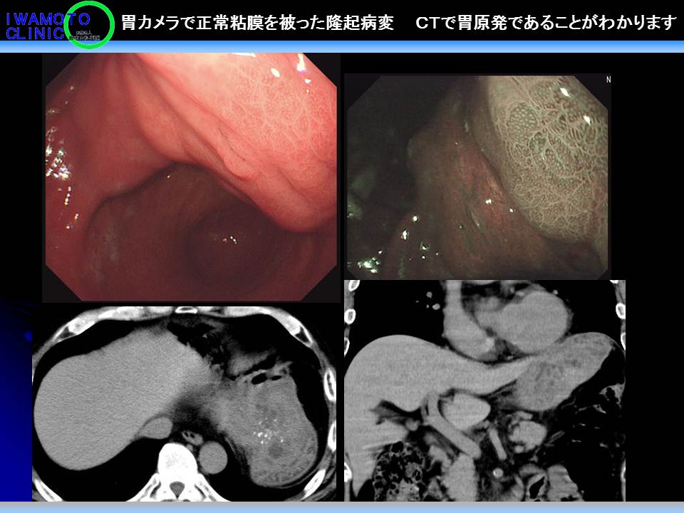 胃カメラで正常粘膜を被った隆起病変　　ＣＴで胃原発であることがわかります