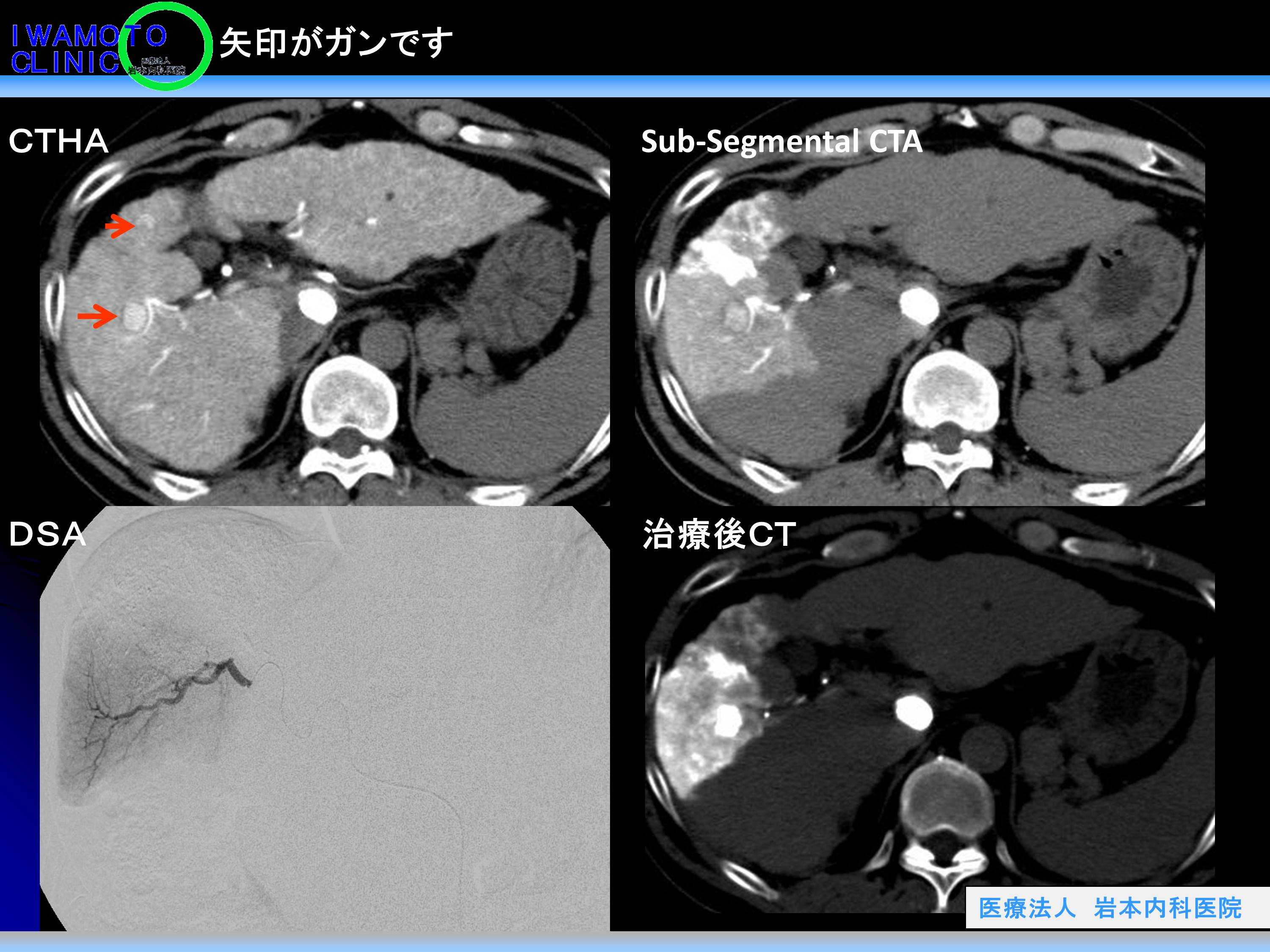 CTHA(肝動脈造影CT)で白くなる小さな結節がありました2