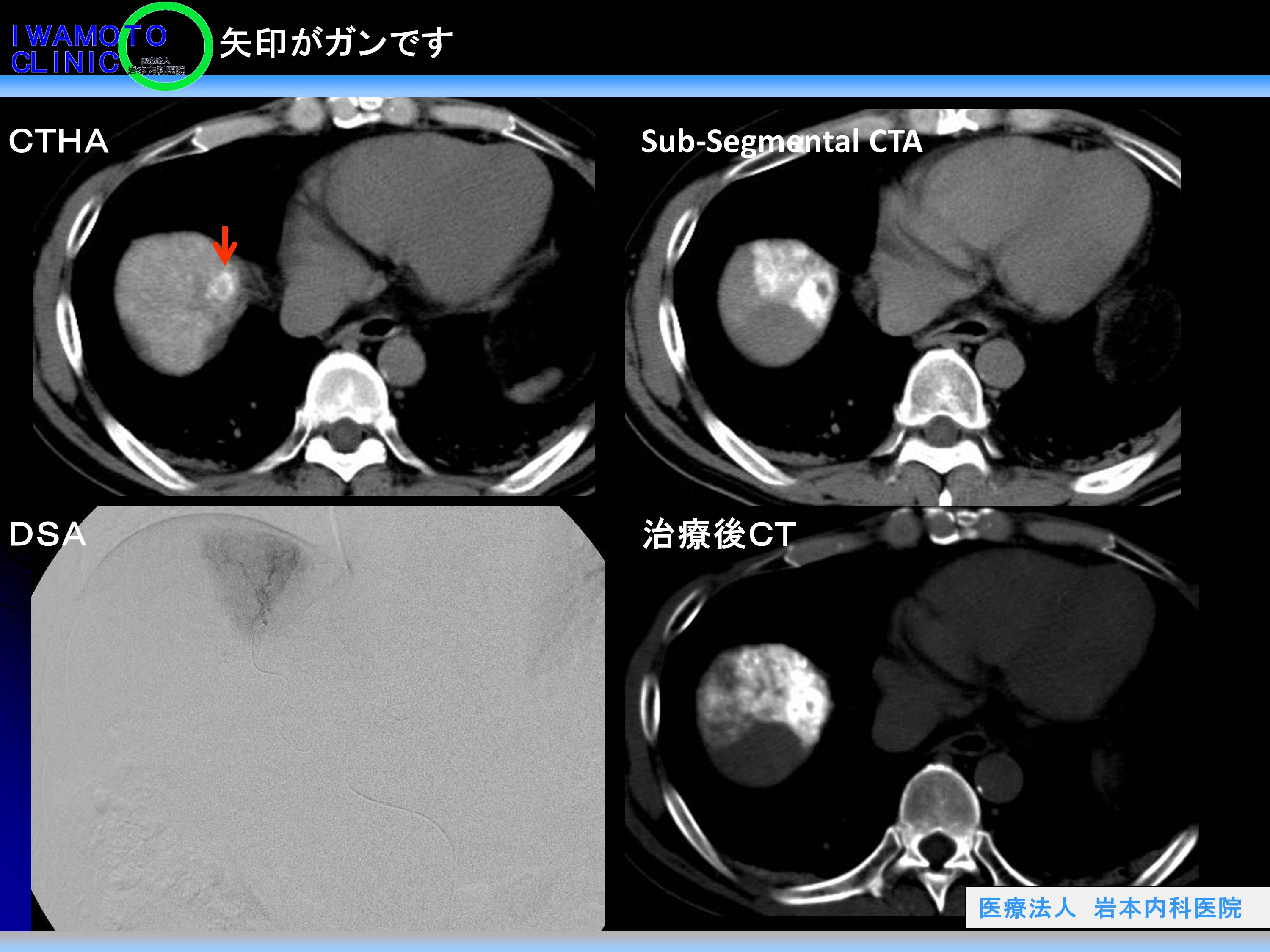 CTHA(肝動脈造影CT)で白くなる小さな結節がありました