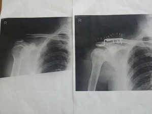 肩の手術1