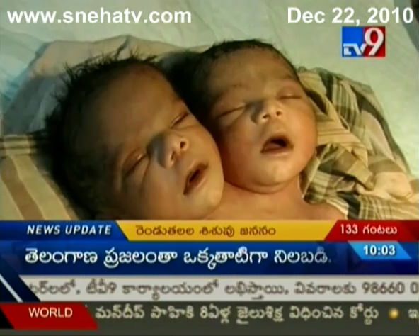 インドのアンドラ・プラデシュ州で生まれた二頭体双生児 