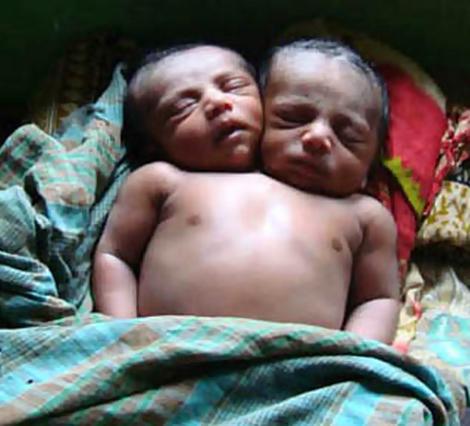 バングラデシュで生まれた二頭体双生児（兄弟）