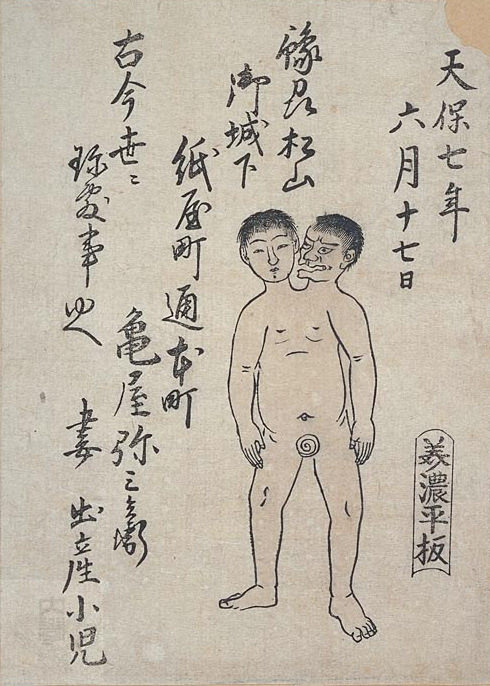 江戸時代、予州松山で生まれた二頭体双生児